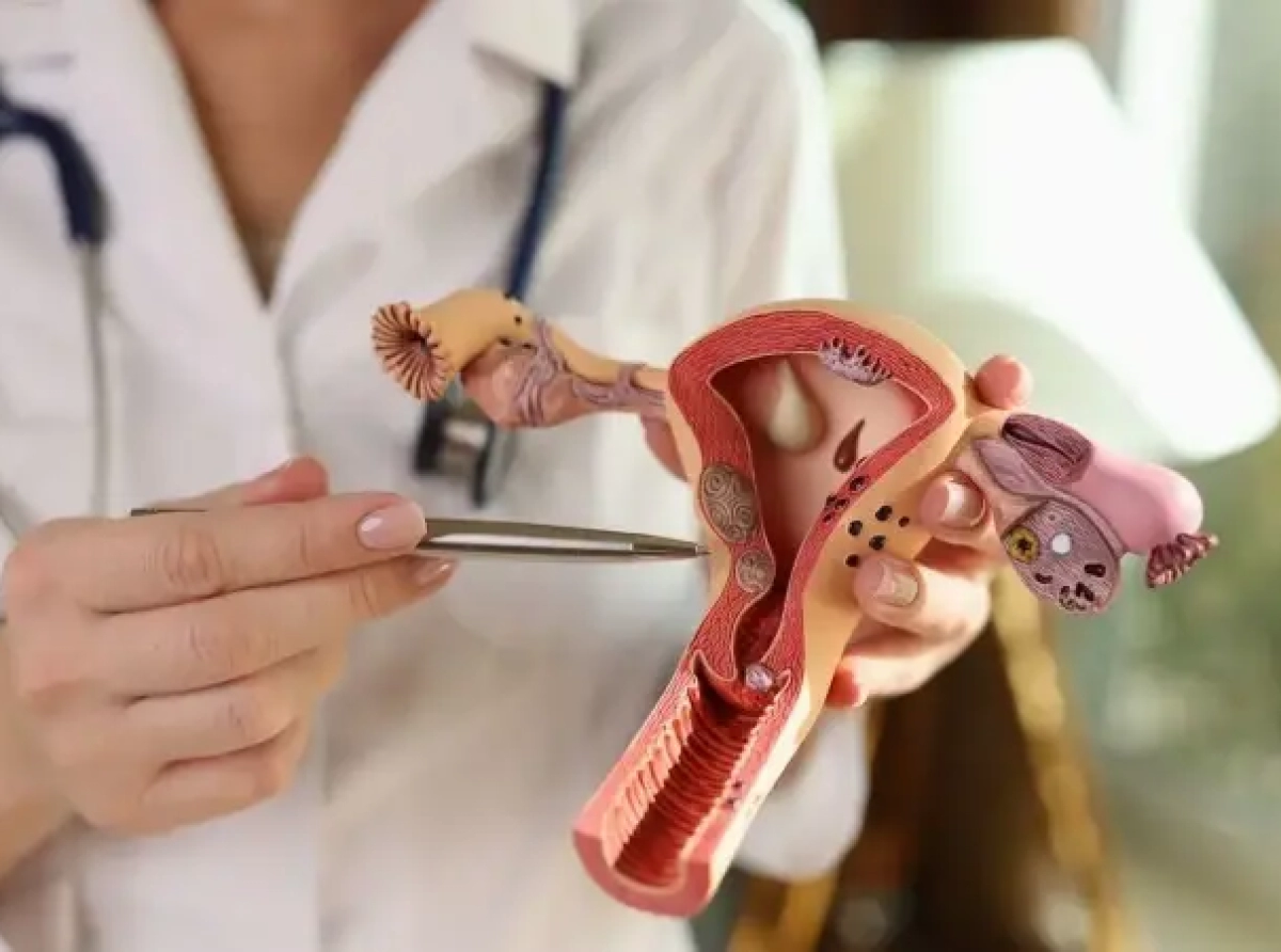 Çocuk sahibi olamamanın en önemli nedenlerinden biri:  Endometriozis (Çikolata Kistleri ) 