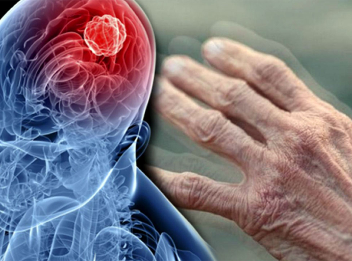 Parkinson hastalığına bağlı gelişen psikoz tedavisi tıbbın hizmetine sunuldu