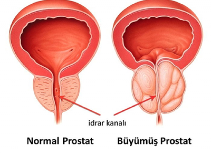 Prostat Kanserinin Sessiz Yüzüne Dikkat !