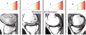 menisküs3