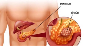 pankreas kanseri 3