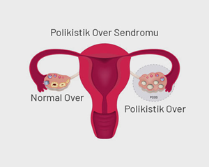 polistikover2